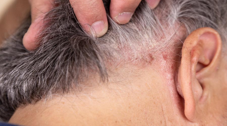 Dermatitis seborreica: tratamiento y cuero cabelludo